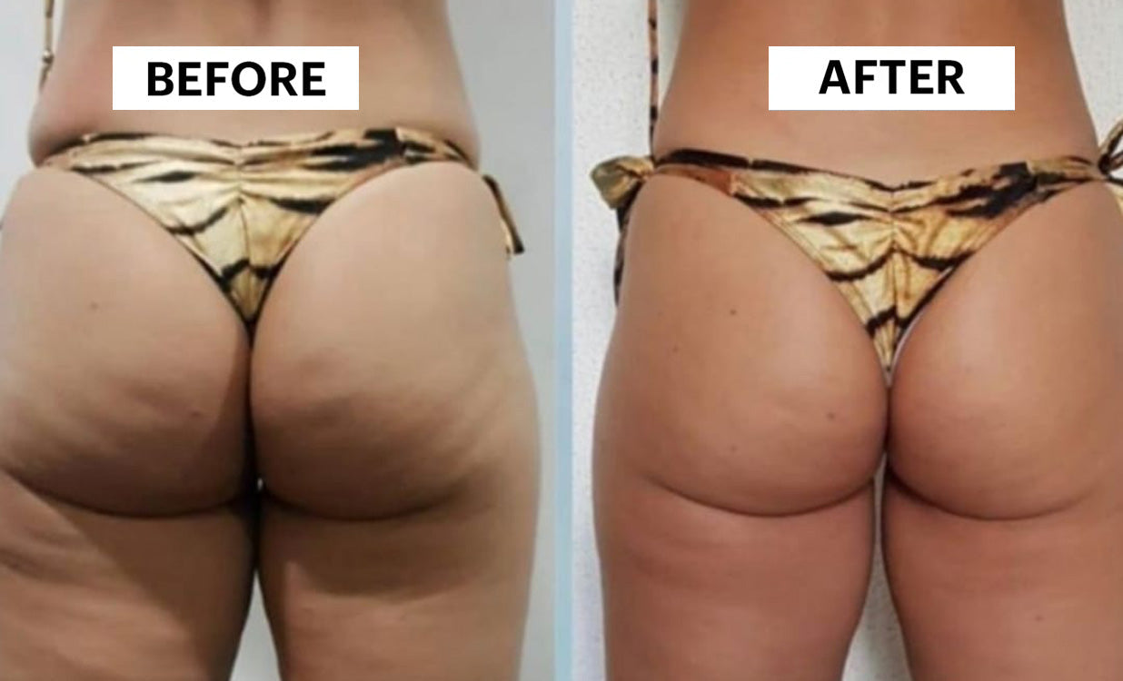 Electric Cupping Massager