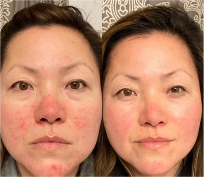 Facial Lifting Beauty Eye Pad